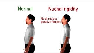 Nuchal rigidity  pathognomonic sign of meningeal irritation [upl. by Nawk]