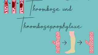 Thromboseprophylaxe Examensfrage [upl. by Arty637]