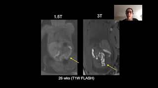 Topics in Fetal Medicine MR Fetal Imaging [upl. by Eltotsira]