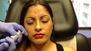 Botox amp Juvederm Voluma Injections for Young Women [upl. by Hendren409]