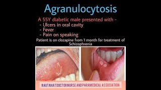 Agranulocytosis Symptoms and Causes  Diagnosis  Treatment  Prevention [upl. by Hotze676]