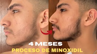 4 MESES USANDO MINOXIDIL PARA CRECER BARBA SIENDO 100 LAMPIÑO [upl. by Larson]