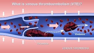 Understanding and Diagnosing Venous Thromboembolism VTE [upl. by Enywad]