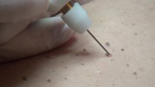 Hyperkeratosis removal with Plexr [upl. by Nerad440]