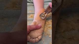 Removing callus from kid feet  Keratoderma hyperkeratosis EPPK skin shaving callous  May 29 2023 [upl. by Bonnie]