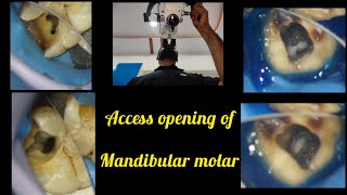 Access opening of Mandibular 1stmolarrct for beginners step by step root canal treatmentrctbasics [upl. by Meilen428]