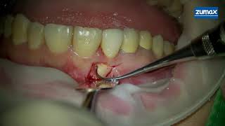 Root resorption repair [upl. by Ailak]