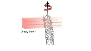 Investigation on the bioresorbable coronary scaffold resorption invivo [upl. by Ede]