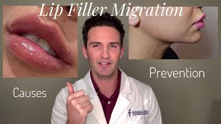 Lip Filler Migration Causes amp Prevention [upl. by Howlyn]