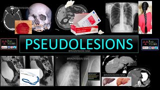 PSEUDOLESIONS [upl. by Nere658]