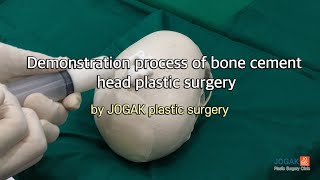 Demonstration process of bone cement head plastic surgery [upl. by Jorgenson]