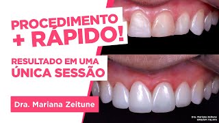 TRANSFORME SEU SORRISO Facetas e lentes de contato em resina composta Saiba tudo [upl. by Dougal]