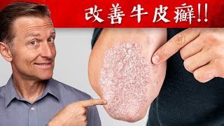 【皮膚】牛皮癬、濕疹、皮膚炎的草藥膏自然療法柏格醫生 Dr Berg [upl. by Arreit446]