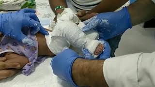 CLUBFOOT correction by PONSETI casting TECHNIQUE [upl. by Aneetsirk809]