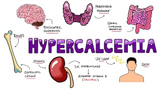 An Approach to Hypercalcemia  Causes Calcium Homeostasis Mechanisms amp Signs and Symptoms Mnemonic [upl. by Eillen]