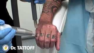 Laser Tattoo Removal Los Angeles CA FBomb Finger Tattoo Removal at Dr TATTOFF in California [upl. by Melentha]