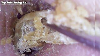 Ear Wax Removal  207 The earwax was so big that he couldnt hear clearly  Ear Cleaning ASMR [upl. by Ecnarrat]