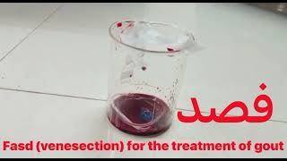 Fasd Venesectionan effective blood letting procedure in Unani Medicine [upl. by Rempe]