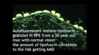 Why is lipofuscin in the retinal pigment epithelium toxic [upl. by Nele323]