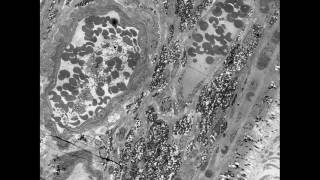 What is the mode of action of antivascular endothelial growth factor drugs in wet AMD [upl. by Zetta]