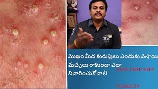 SKINDISEASES FOLLICULITIS amp FURUNCULOSIS TREATMENT IN TELUGU HOMEOPATHY WAKEUP [upl. by Mosby]