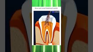 Everything You Need to Know About Root Canal Treatment  Dental Care Explained [upl. by Nickerson]