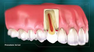 What Is Root Canal Treatment [upl. by Luaped790]