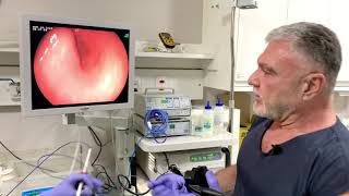 Endoscopia  Queixa de Dor Abdominal Azia e Vômito [upl. by Euridice]