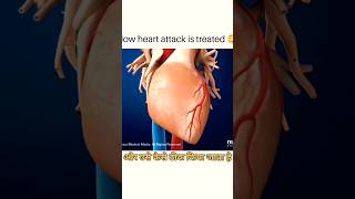 How Heart Attack occurs heartattack heart heartbroken facts factsinhindi shorts short [upl. by Ahsayn]