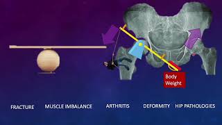 Hip Joint Biomechanics and arthroplasty Simplified Basics Part 1 of 3 [upl. by Sulokcin]