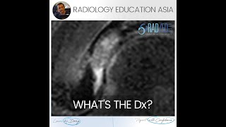 WHATS THE DX HIP MRI LABRUM MUCOID DEGENERATION [upl. by Arten466]