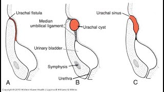 URACHAL ABNORMALITIES [upl. by Aileda]