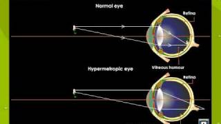 Hypermetropia or Hyperopia [upl. by Innavoig22]