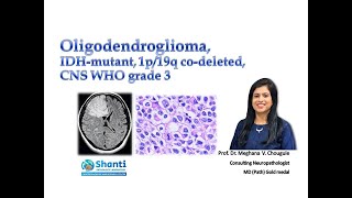 Oligodendroglioma IDH1mutant 1p19q codeleted [upl. by Ditzel]