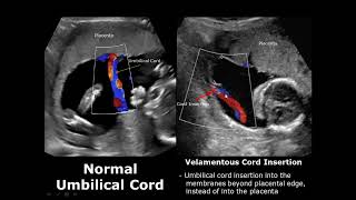 Umbilical Cord Ultrasound Normal Vs Abnormal Image Appearances Comparison  Fetal USG  Obstetric [upl. by Hagerman680]