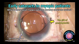 CataractCoach™ 2220 early cataracts in myopic patients  why [upl. by Chance618]