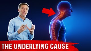 Scoliosis Kyphosis Lordosis and Vitamin D Explained by DrBerg [upl. by Aihsram347]