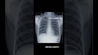 Normal vs Abnormal xray xray radiology xraytech radtech radiologist mri radiologia xrays [upl. by Perl]