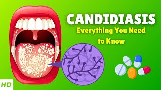 Candidiasis Candida Infection – Causes Signs and Symptoms Diagnosis amp Treatment [upl. by Lletnahc]