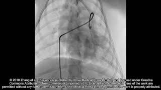 Thrombolytic effect of bolus administration of reteplase  180151 [upl. by Bettina]