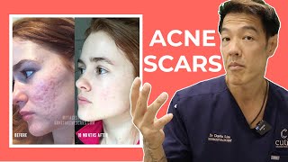 The Best Acne Scar Treatments Explained  Dr Davin Lim [upl. by Eseenaj]