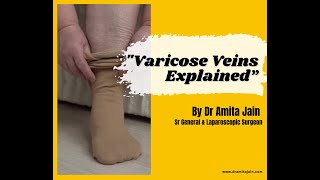 Varicose Veins Symptoms Treatments amp Expert Advice from Delhi NCRs Top Surgeon Dr Amita Jain [upl. by Letta]