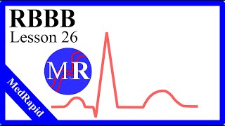 Right Bundle Branch Block RBBB [upl. by Anilorac]