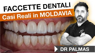 Dr Palmas 🔥Casi Reali di pazienti con faccette e corone dentali [upl. by Tamberg]