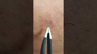 SATISFYING Ingrown Facial Hair Removal With Tweezers [upl. by Paulo]