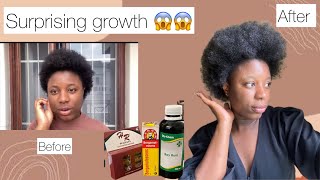 Surprising Results😱 My Hair Growth Journey with bayrum bergamot placenta  Debiee O [upl. by Aivax]