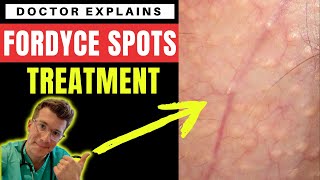 How to treat FORDYCE SPOTS  Doctor ODonovan explains [upl. by Whitman]