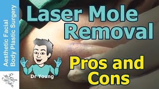 Pros amp Cons of Laser Mole Removal Live Surgery Discussion by Seattle Bellevues Dr Philip Young [upl. by Eeramit]