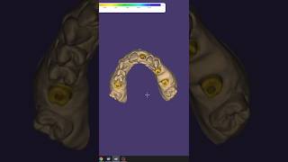 screw retained custom abutment [upl. by Neva]