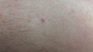 Encapsulated Ingrown Hairs [upl. by Erena431]